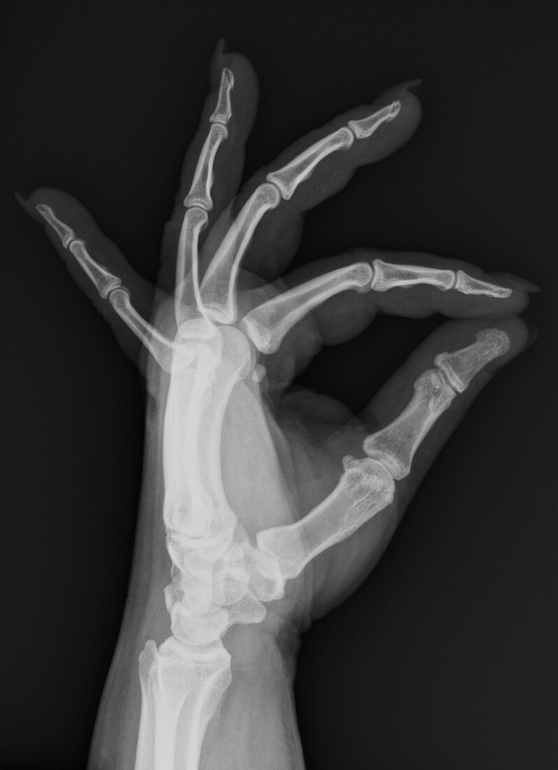 Normal hand, X-ray