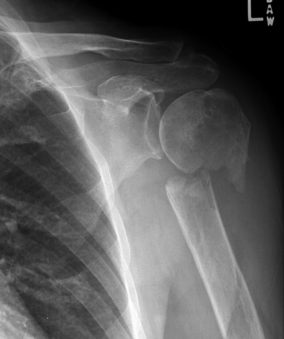 Humeral neck fracture, X-ray