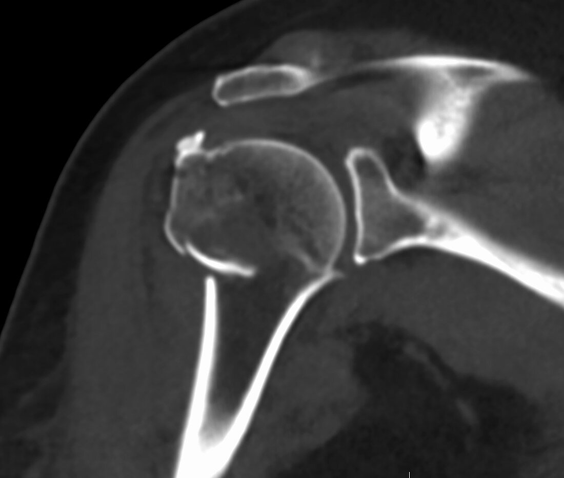 Humeral neck fracture, CT scan