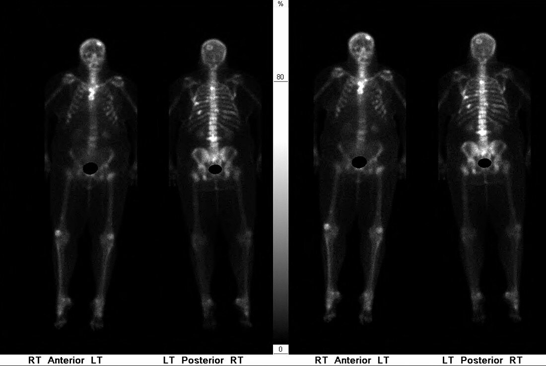 Metastatic cancer, bone scan