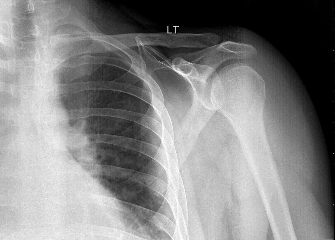 Normal pectoral girdle, X-ray