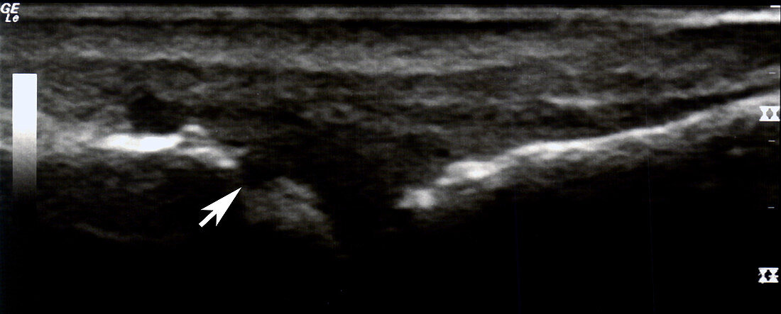 Erosion of metatarsal head, ultrasound