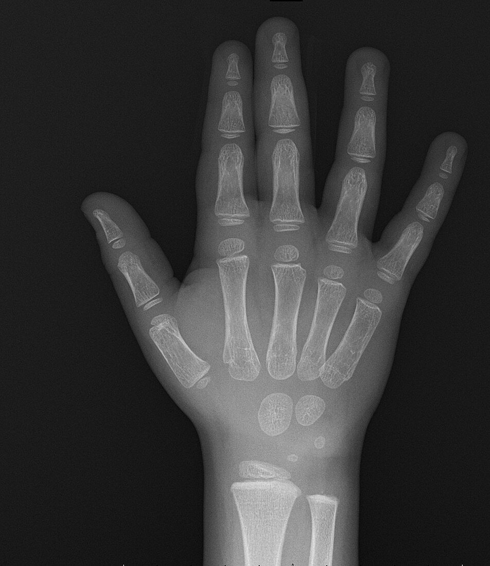 Normal hand of child, X-ray
