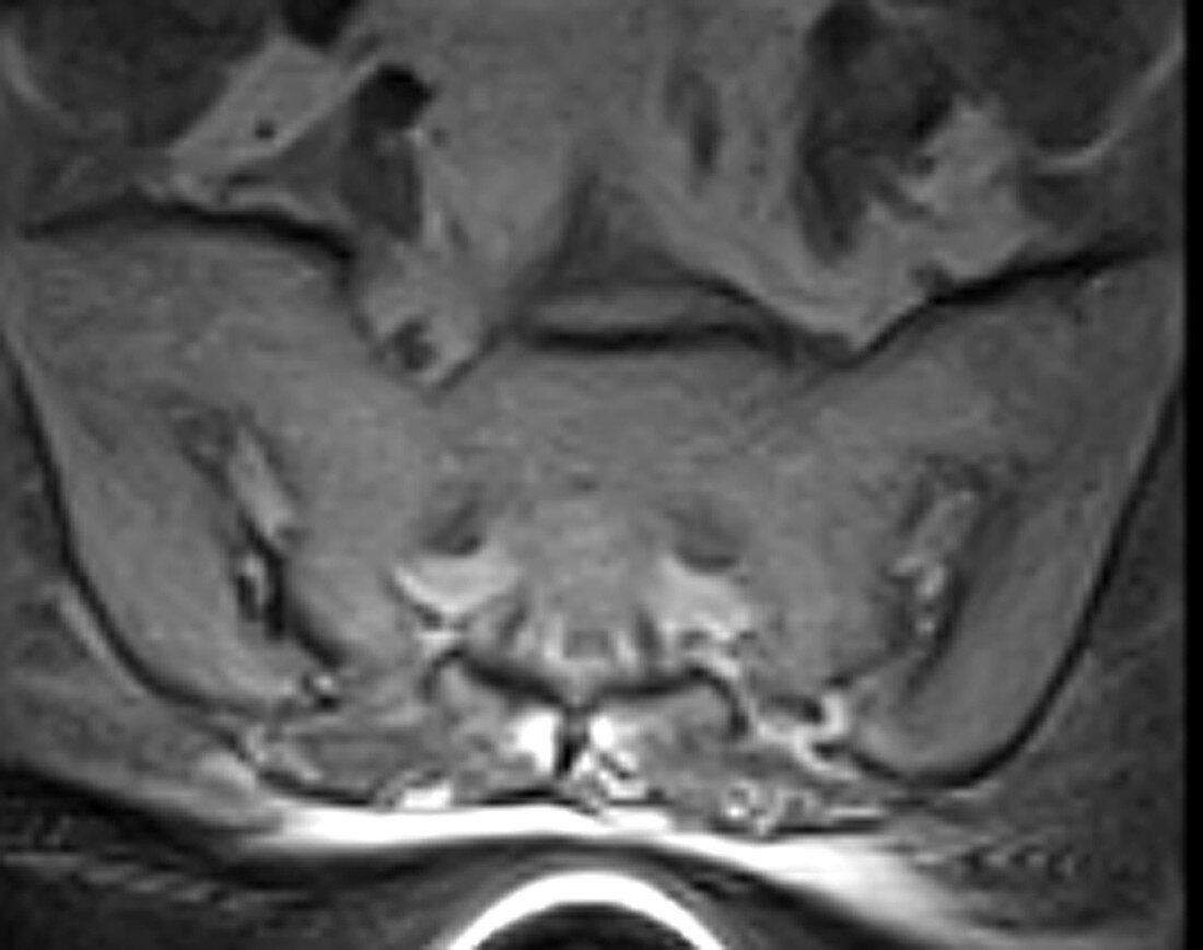 Ankylosing spondylitis, MRI
