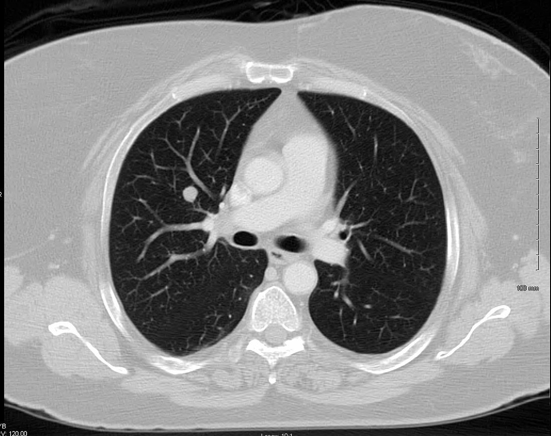 Metastasis in lung, CT scan