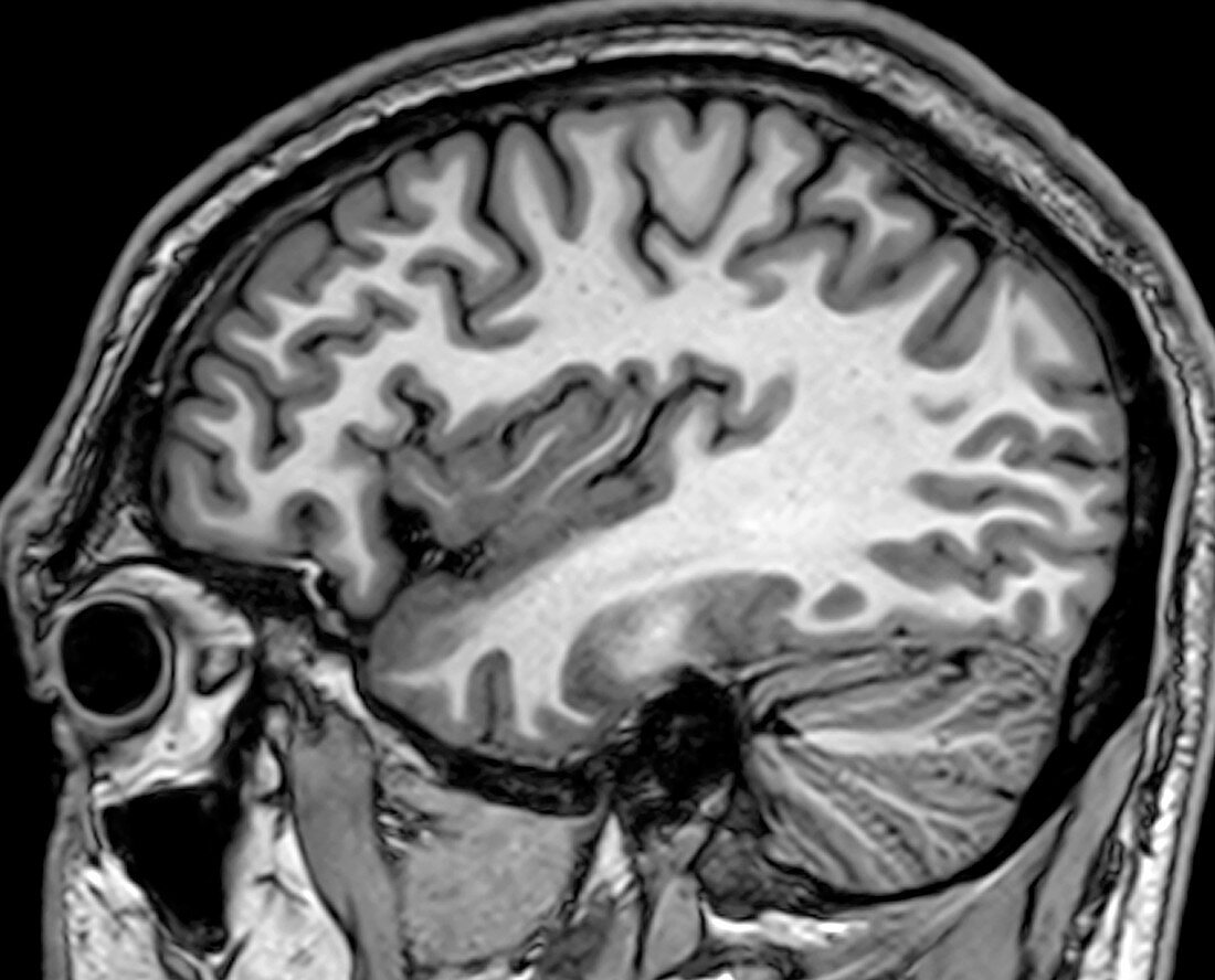 Normal Sagittal T1 MRI Brain 4