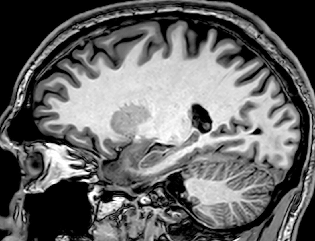 Normal Sagittal T1 MRI Brain 6