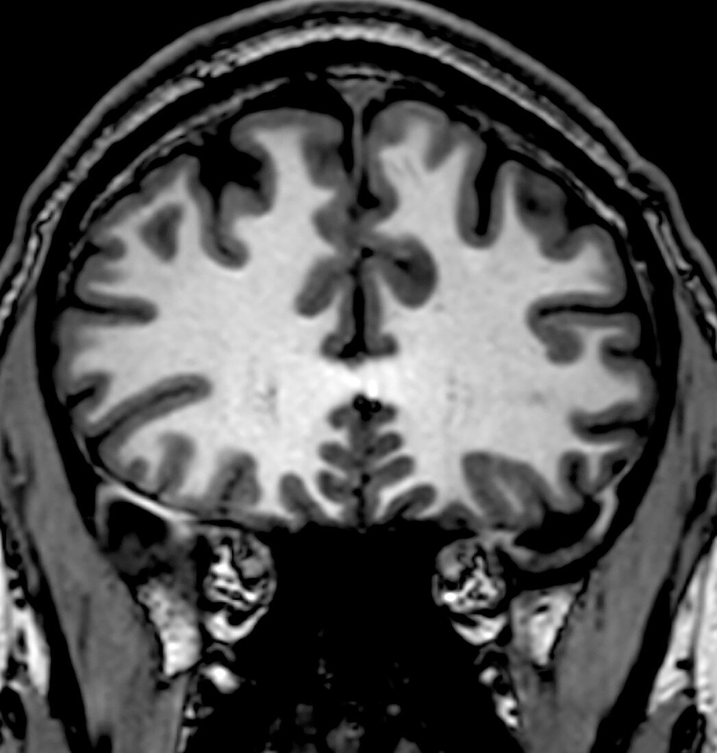 Normal Coronal T1 Brain