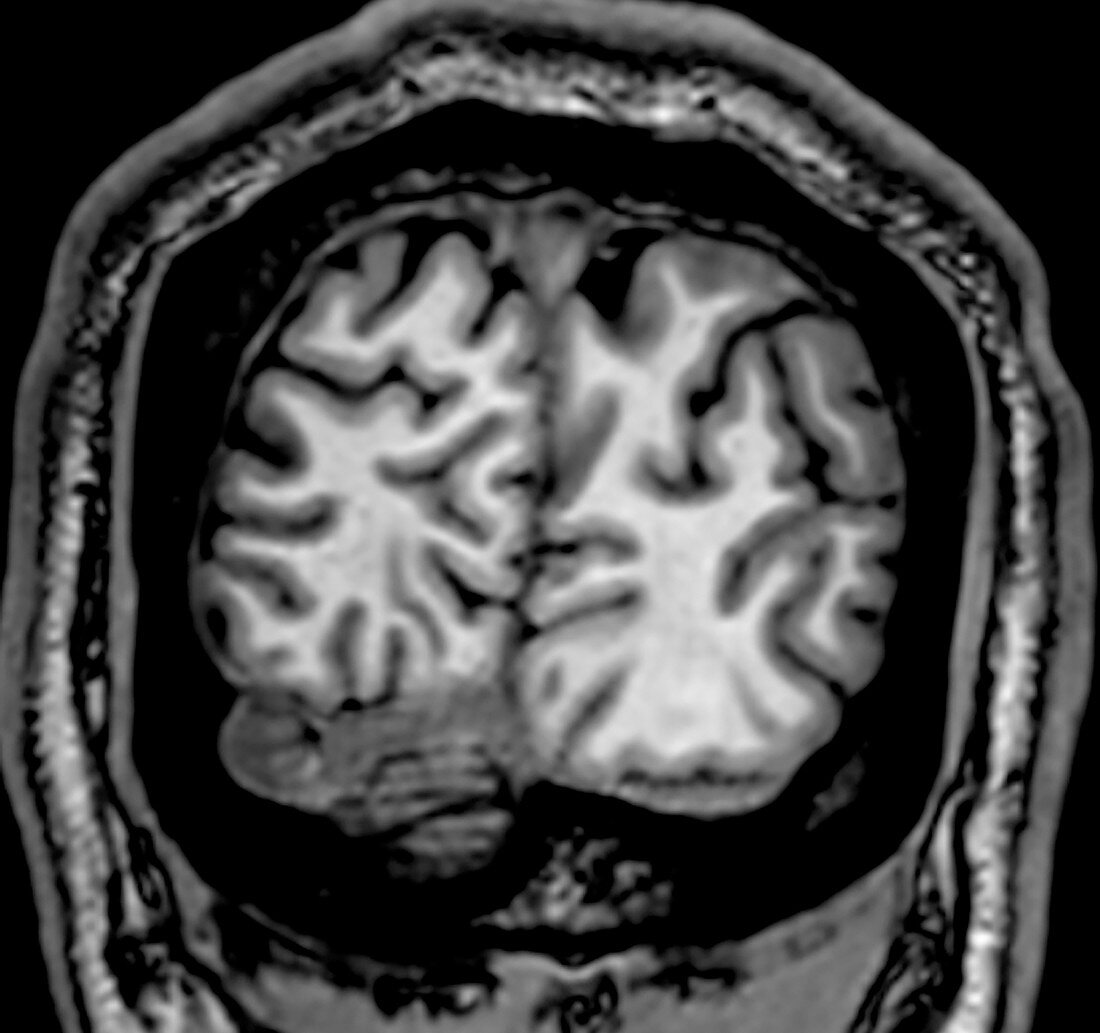 Normal Coronal T1 Brain