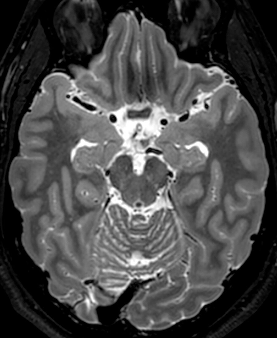 Normal Axial T2 Brain