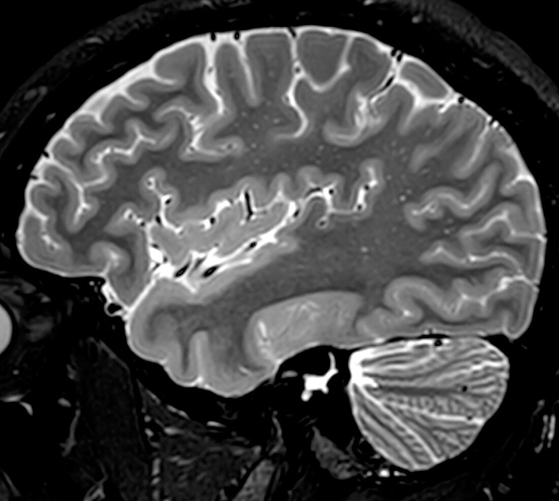 Normal Sagittal T2 Brain 3 0f 11