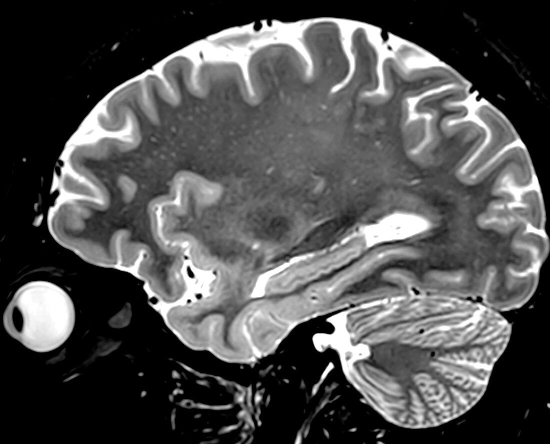Normal Sagittal T2 Brain 5 0f 11