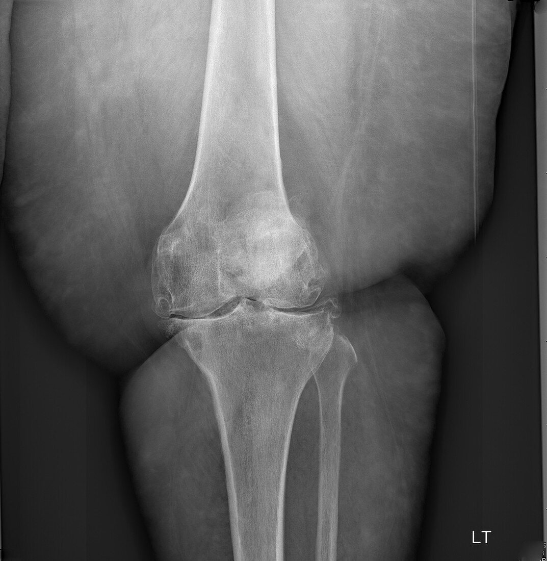 Severe osteoarthritis, X-ray