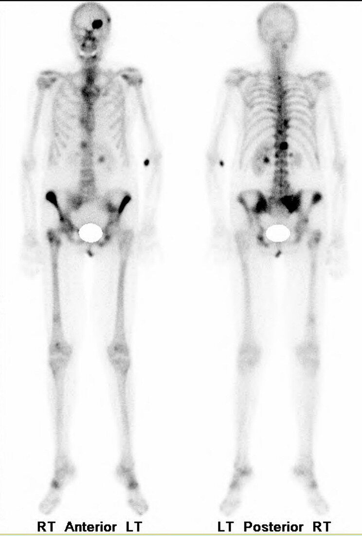 Metastatic renal cell carcinoma, bone scan