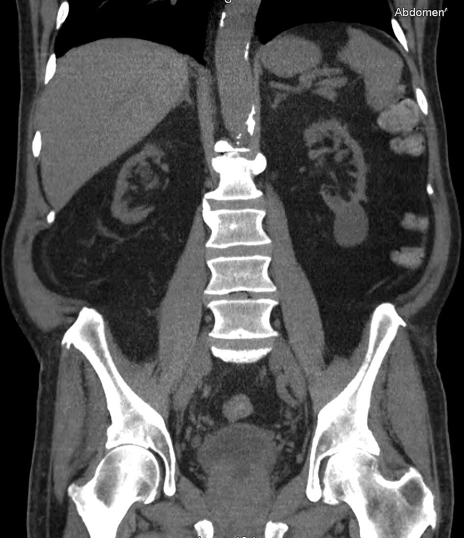 Chronic renal failure, CT scan
