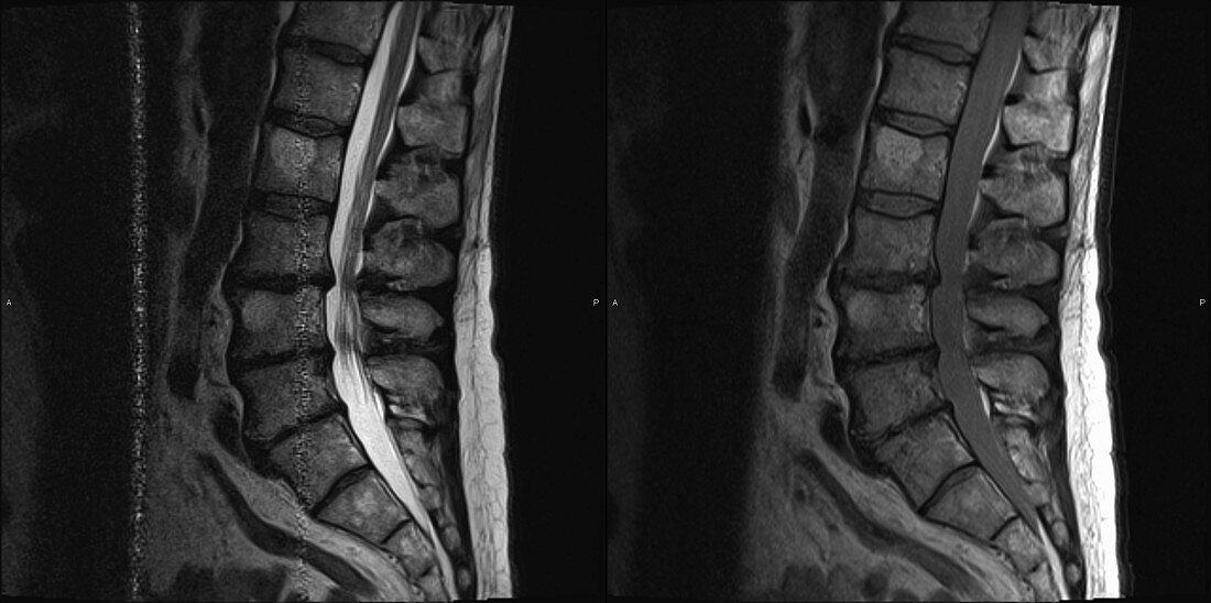 Lumbar spine, MRI, with and without artefacts