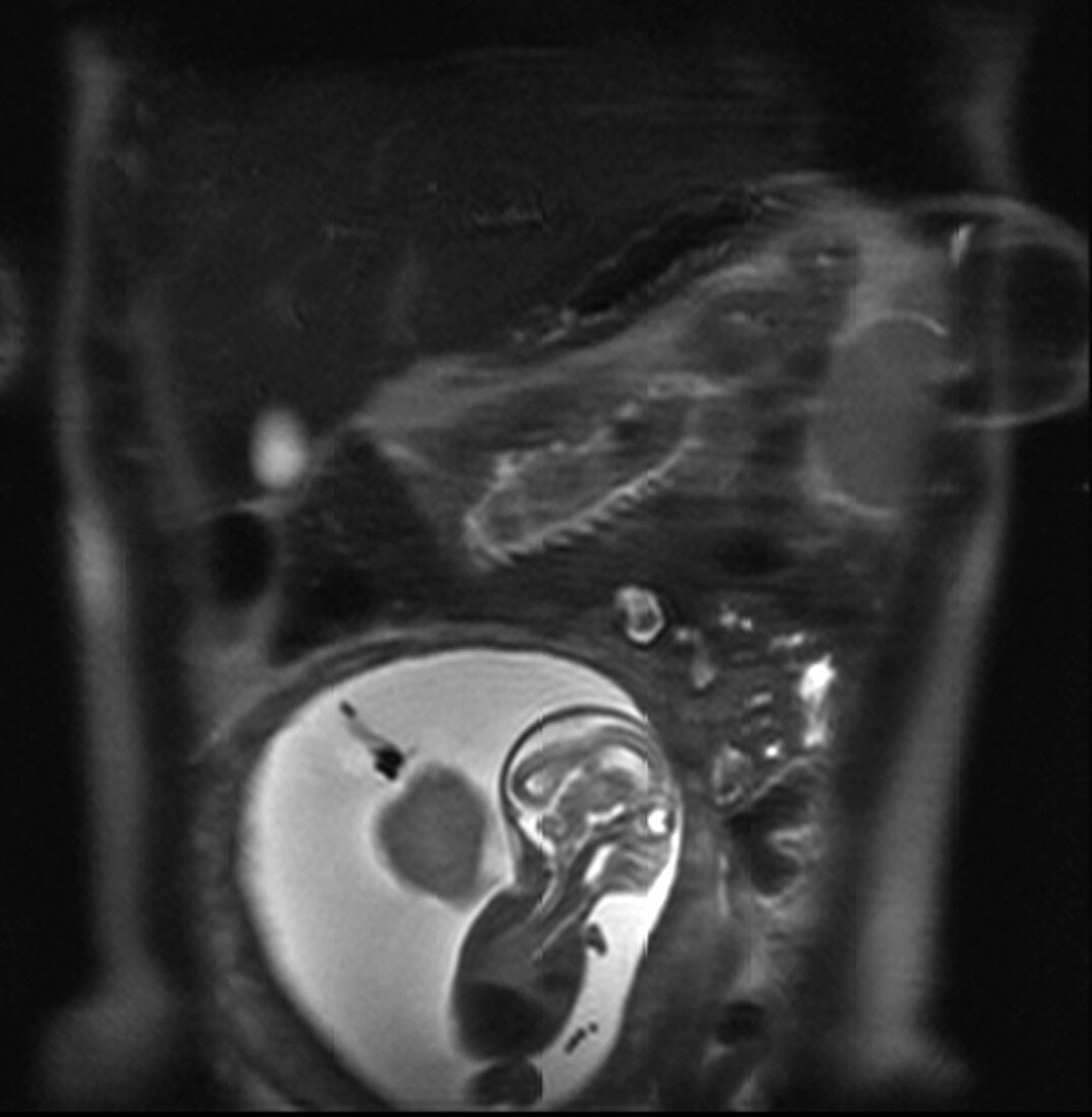 Foetus, 18 weeks, MRI