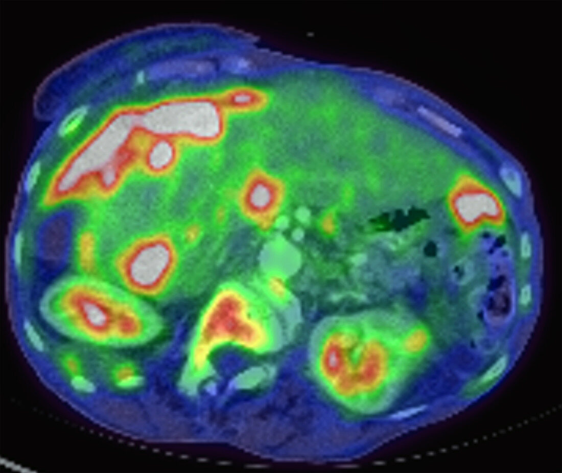 Metastatic ovarian carcinoma, PET CT scan