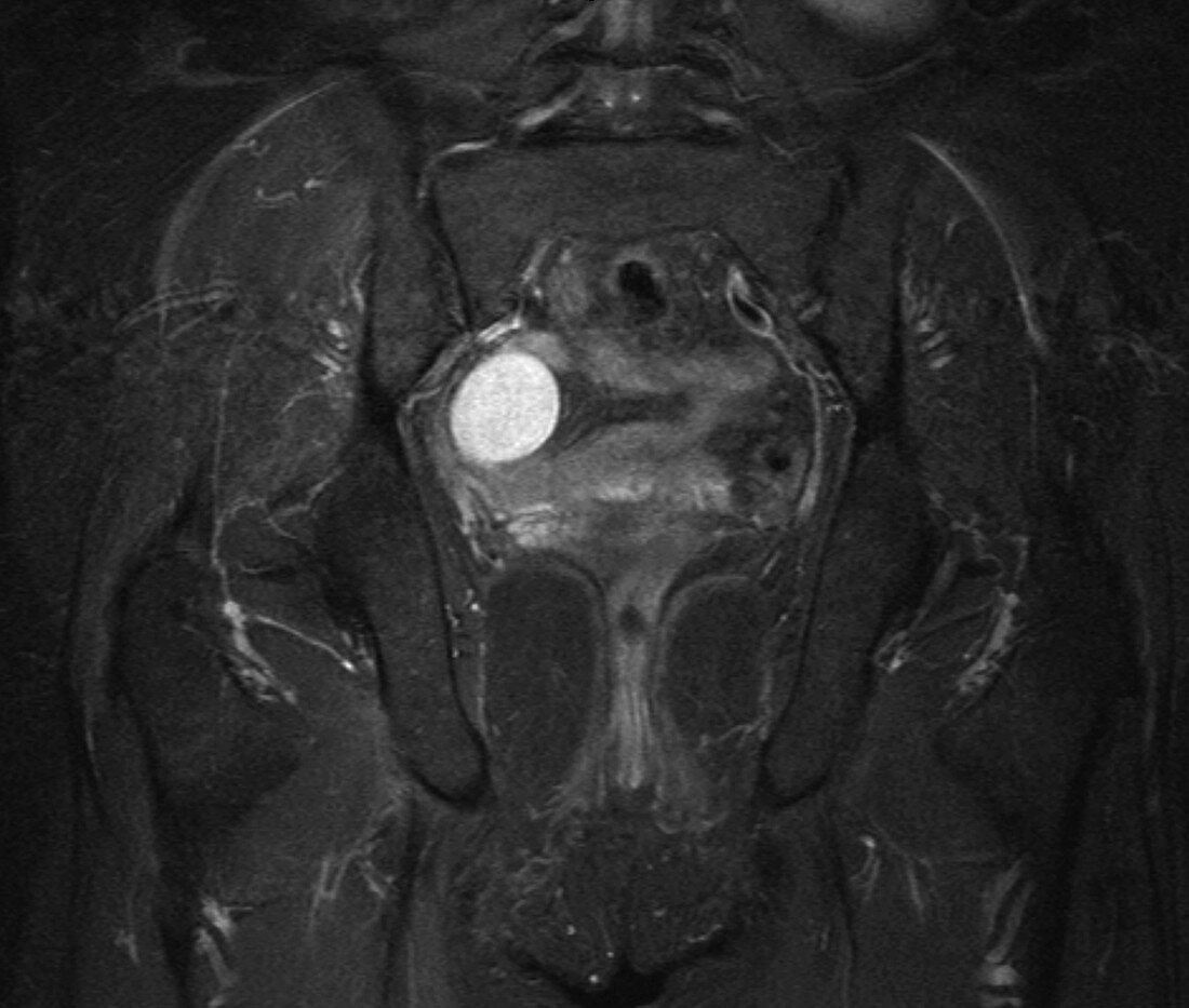 Ovarian cyst, MRI
