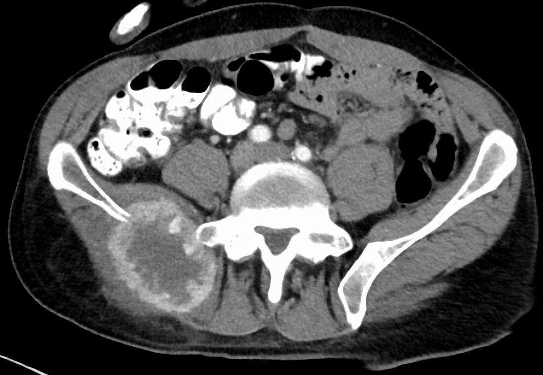 Metastatic renal carcinoma, pelvis, CT scan