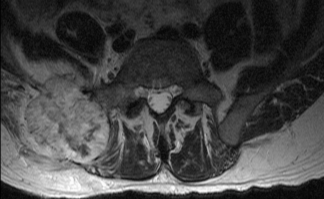 Metastatic renal carcinoma, pelvis, MRI
