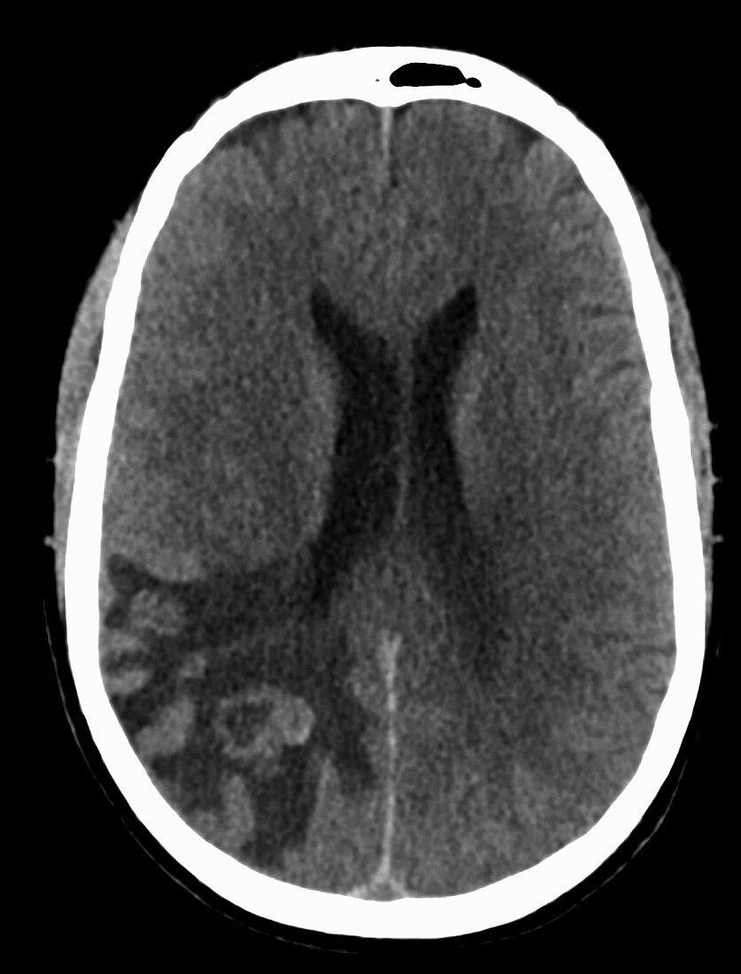 Metastatic renal cell carcinoma, brain, CT scan