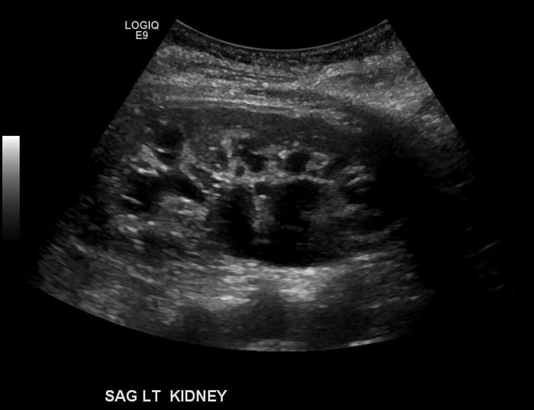 Hydronephrosis, ultrasound