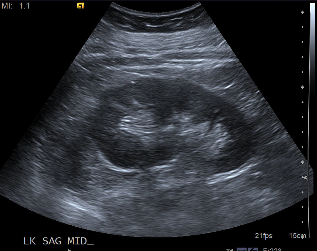 Normal kidney, ultrasound