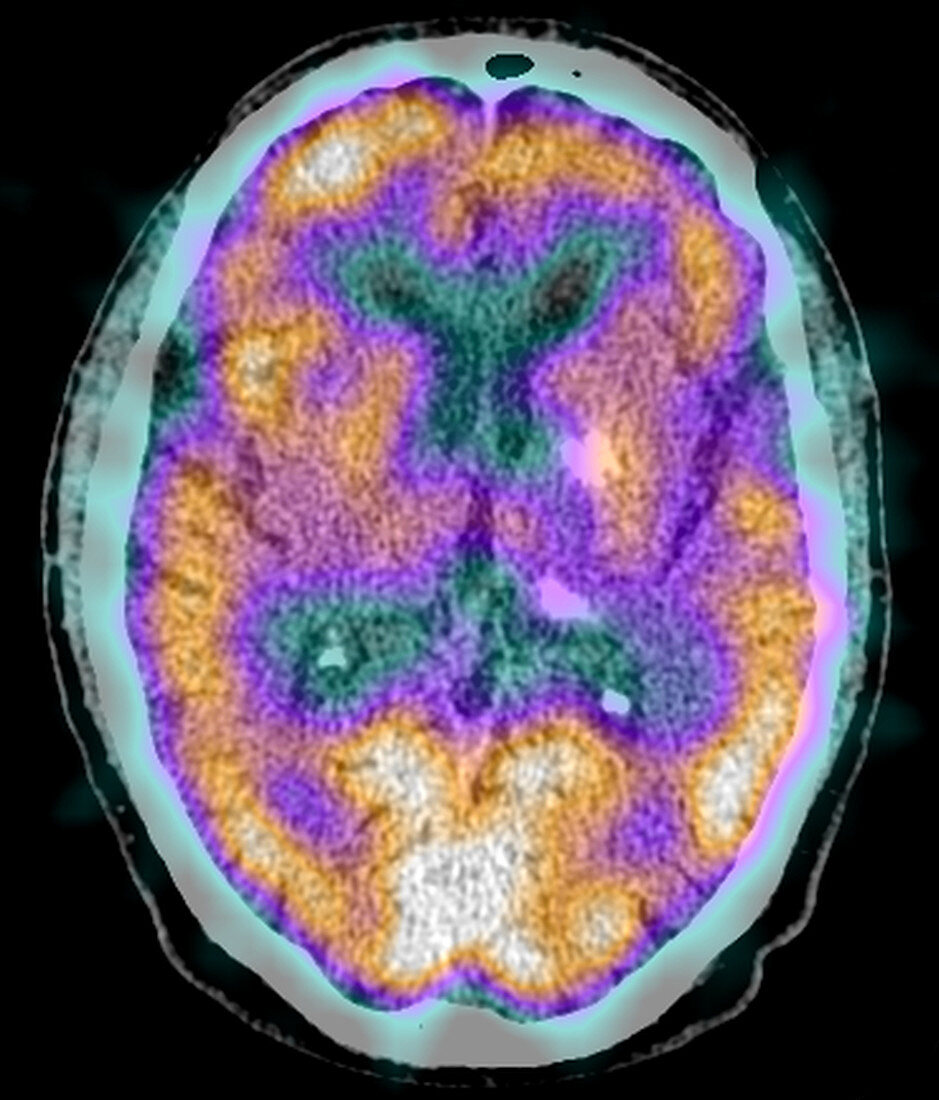 Normal brain, SPECT CT scan
