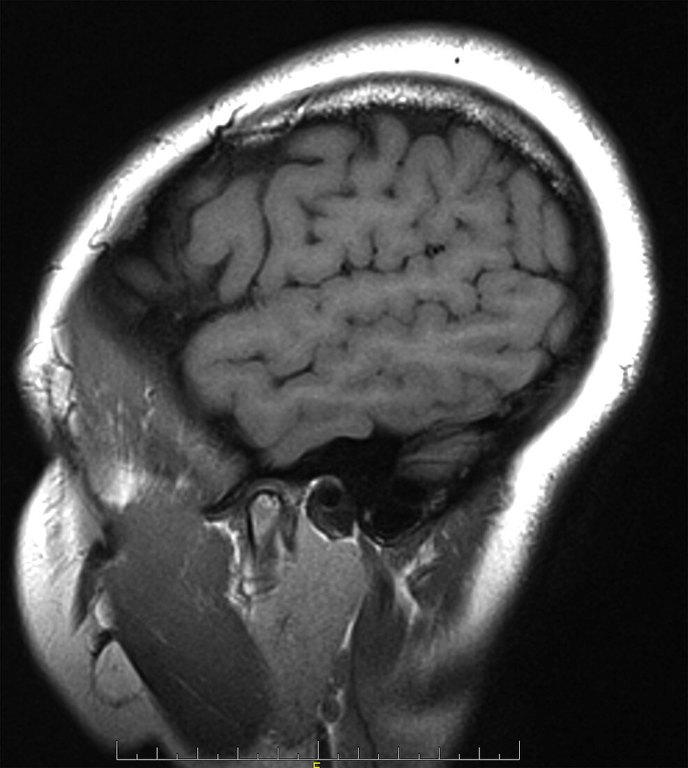 Superior temporal sulcus, MRI