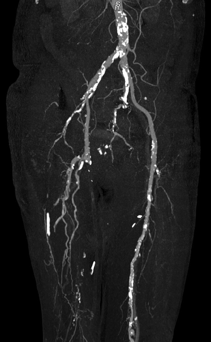 Abdominal aorta, calcification, CT angiography
