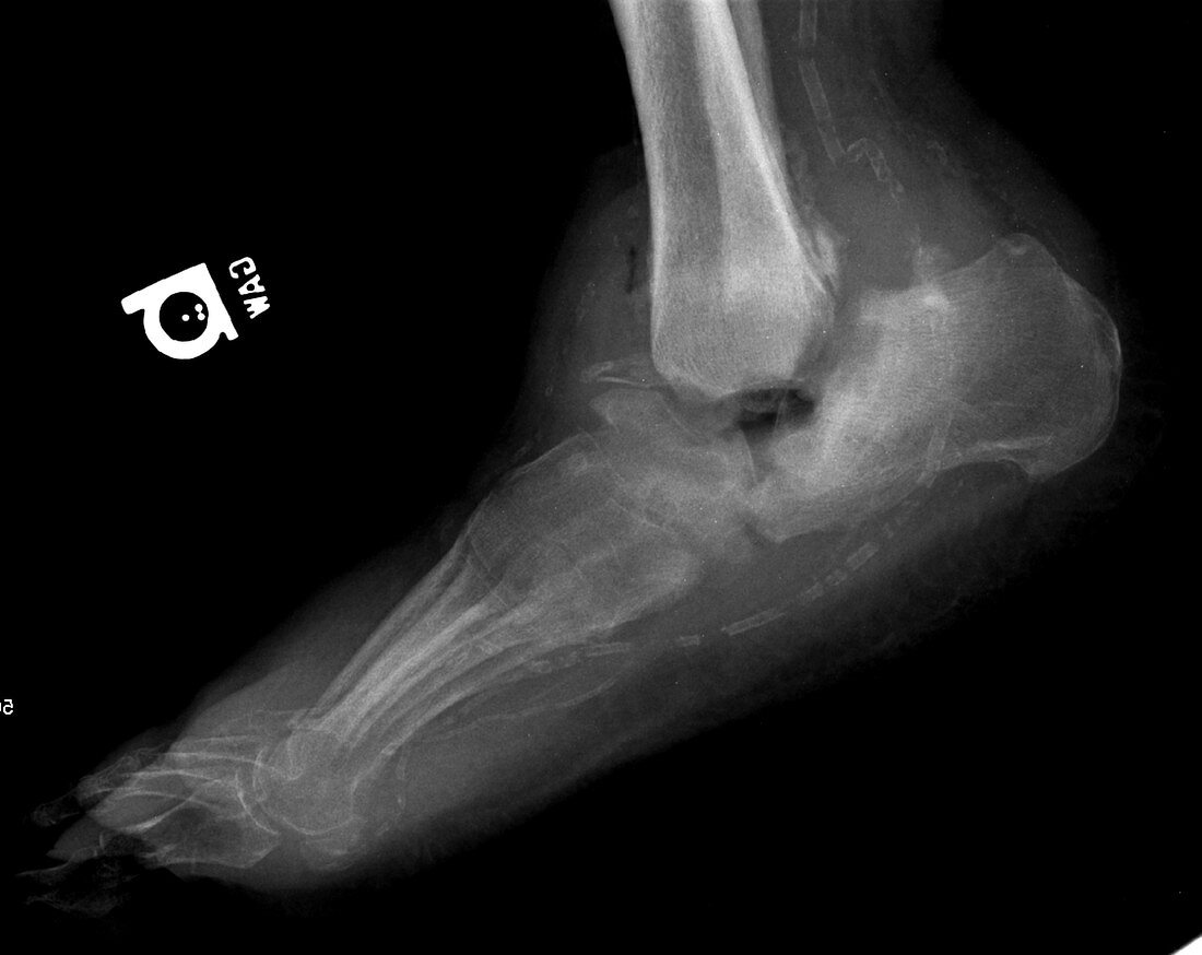 Vascular calcifications in foot, X-ray