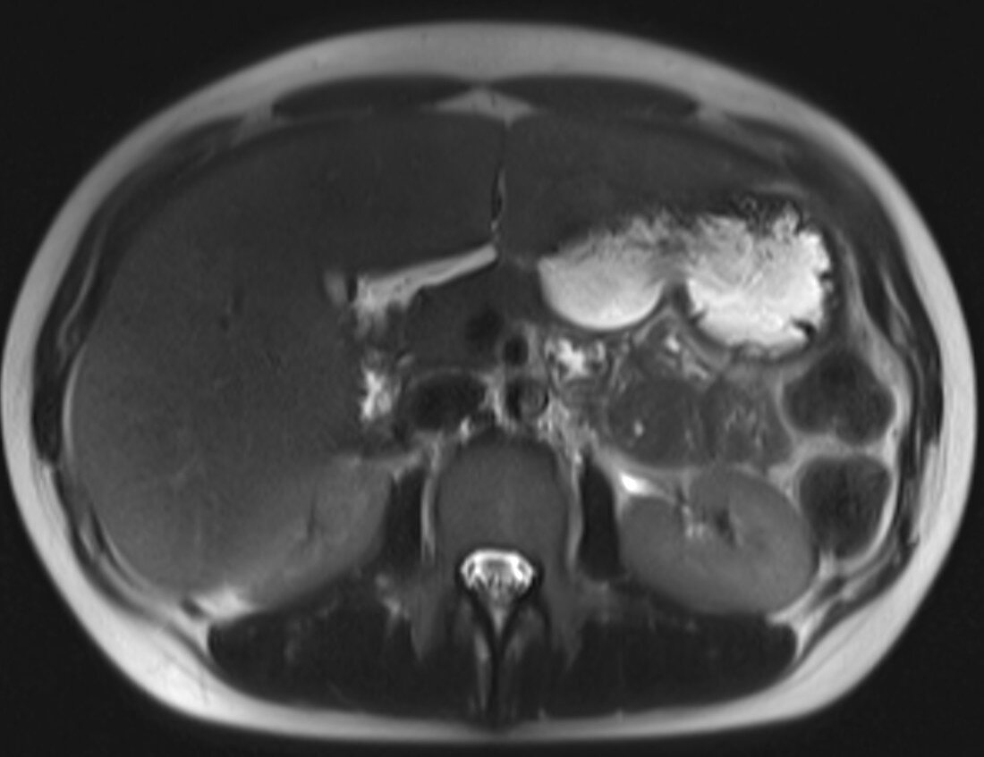 Normal abdomen, lumbar spine, sacrum, MRI