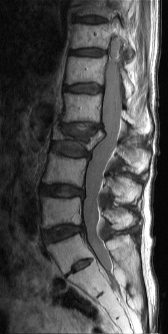 Compression fracture in L3, MRI