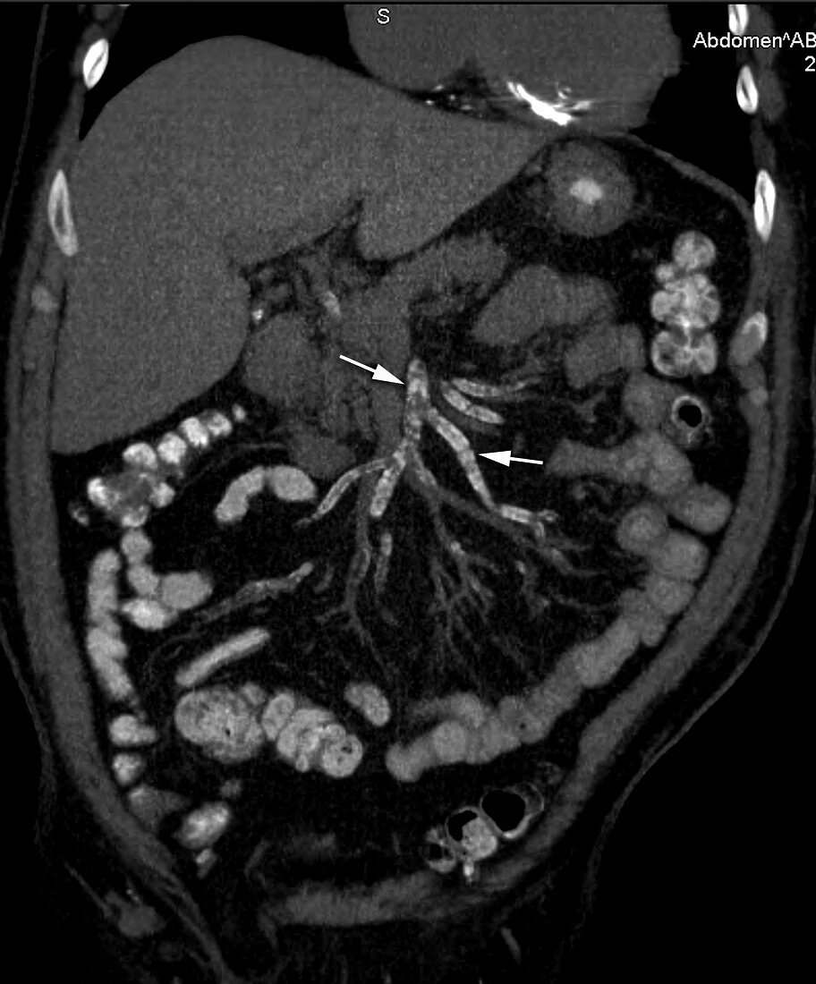 Calcification of mesenteric arteries, CT scan