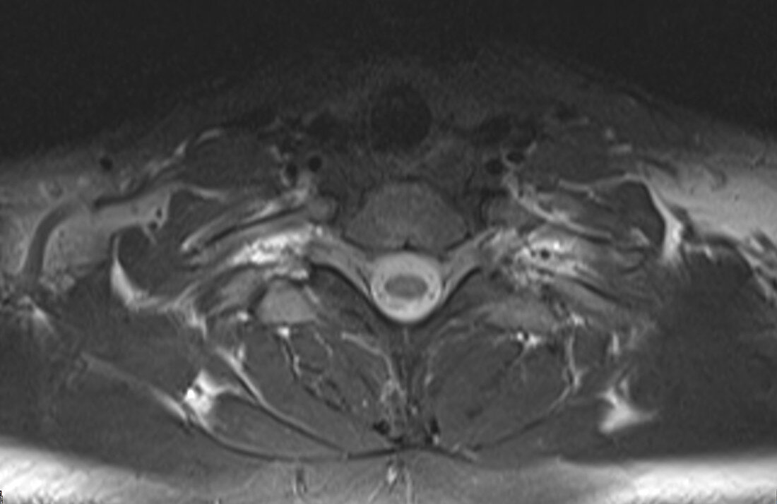 Normal neck and thoracic spine, MRI