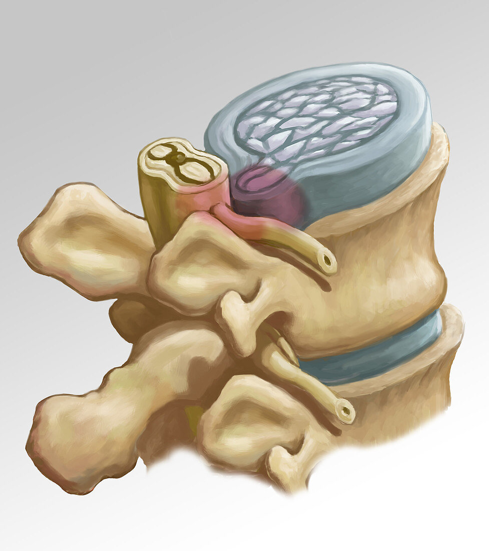 Herniated Disk, illustration