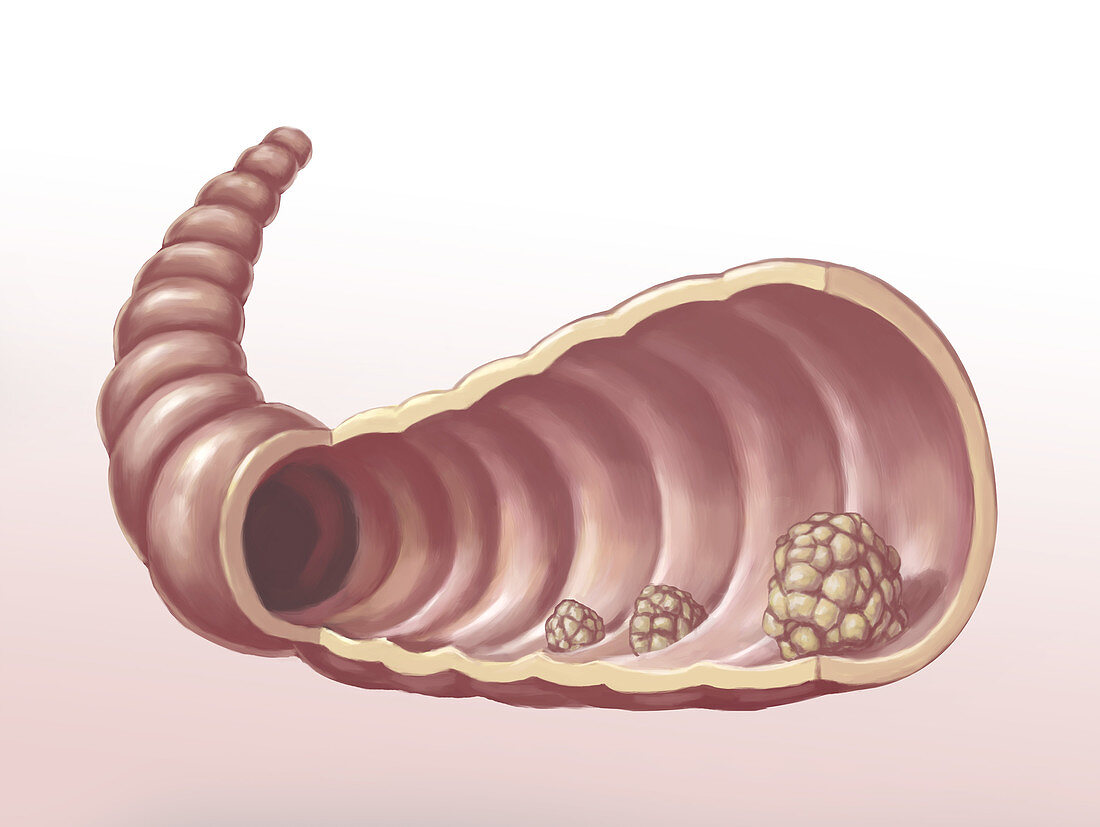 Intestinal Polyps, illustration