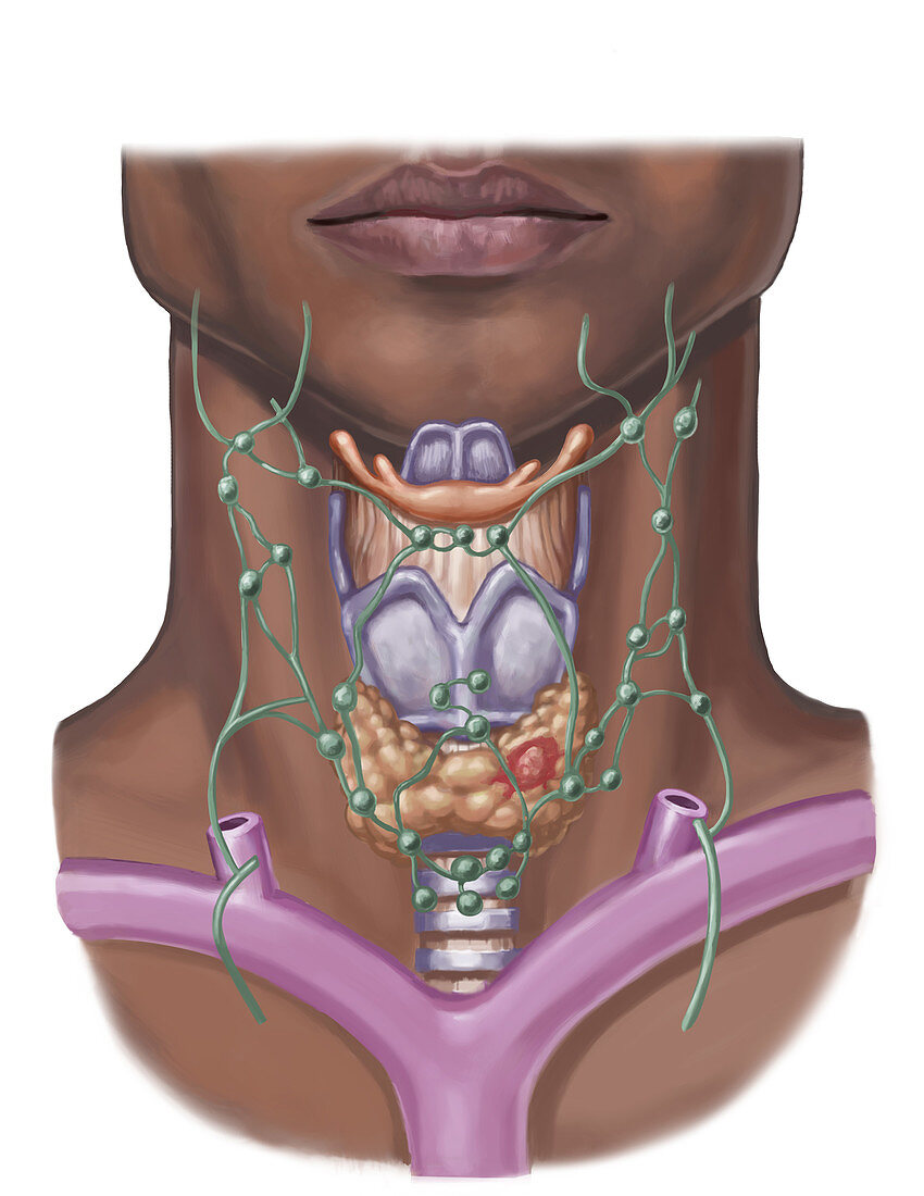 Thyroid Nodule, illustration
