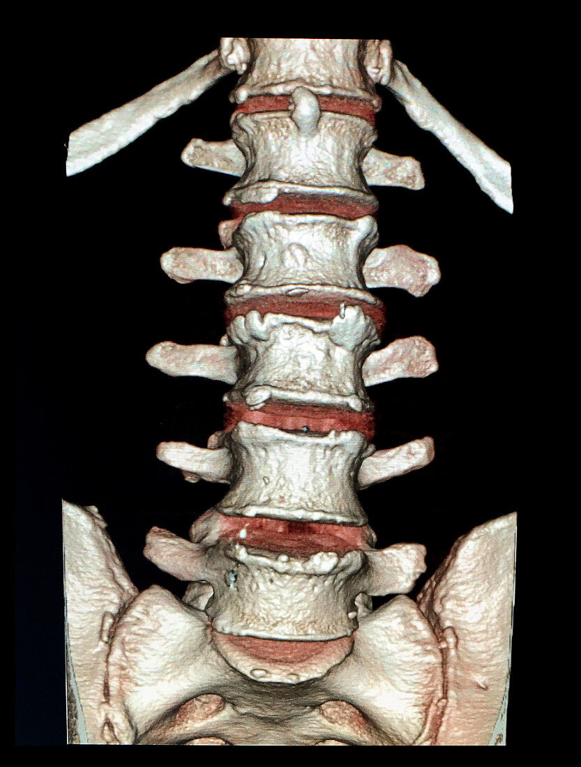 Reconstruction of Lumbar Spine, 3D CT