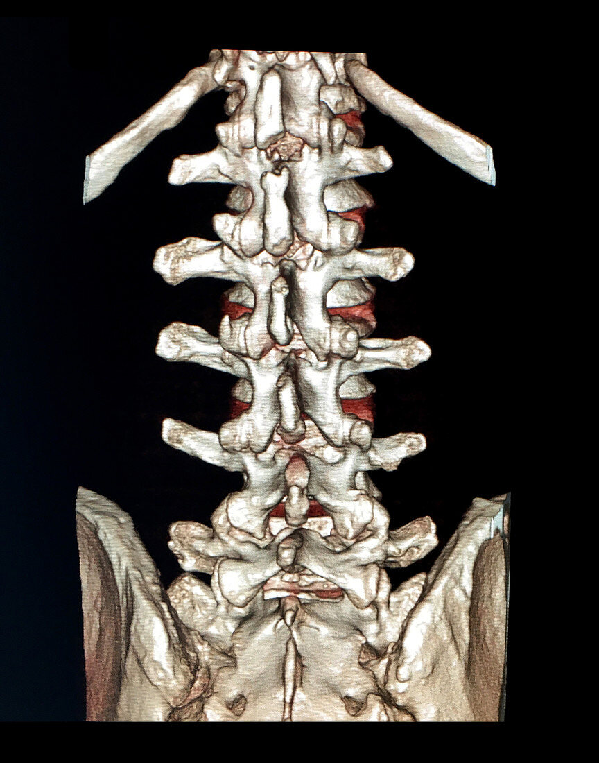 Reconstruction of Lumbar Spine, 3D CT