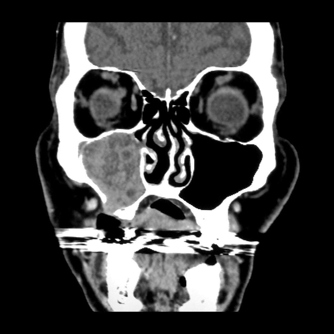 Ameloblastoma of Maxilla, CT
