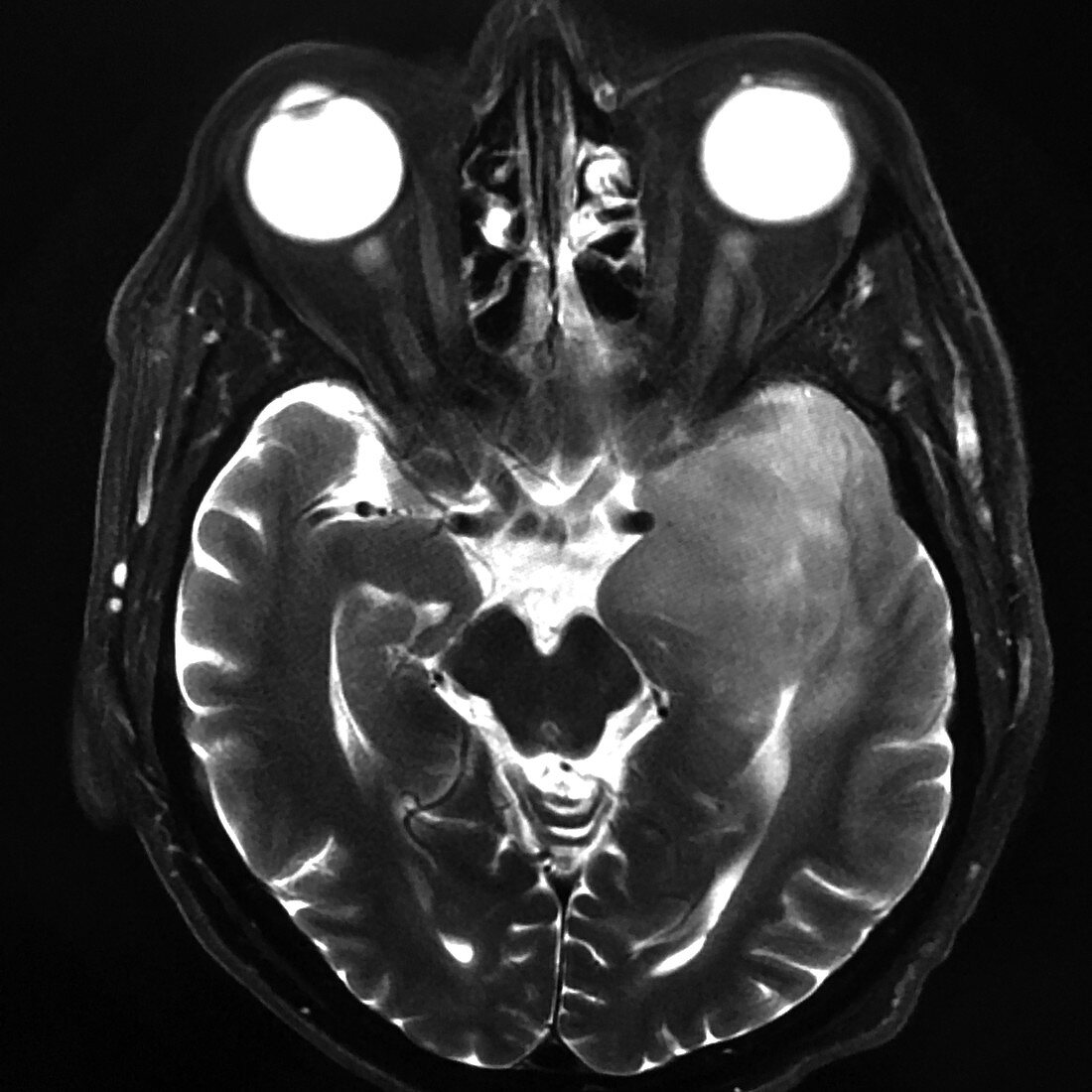 Anaplastic Astrocytoma of Temporal Lobe, MRI