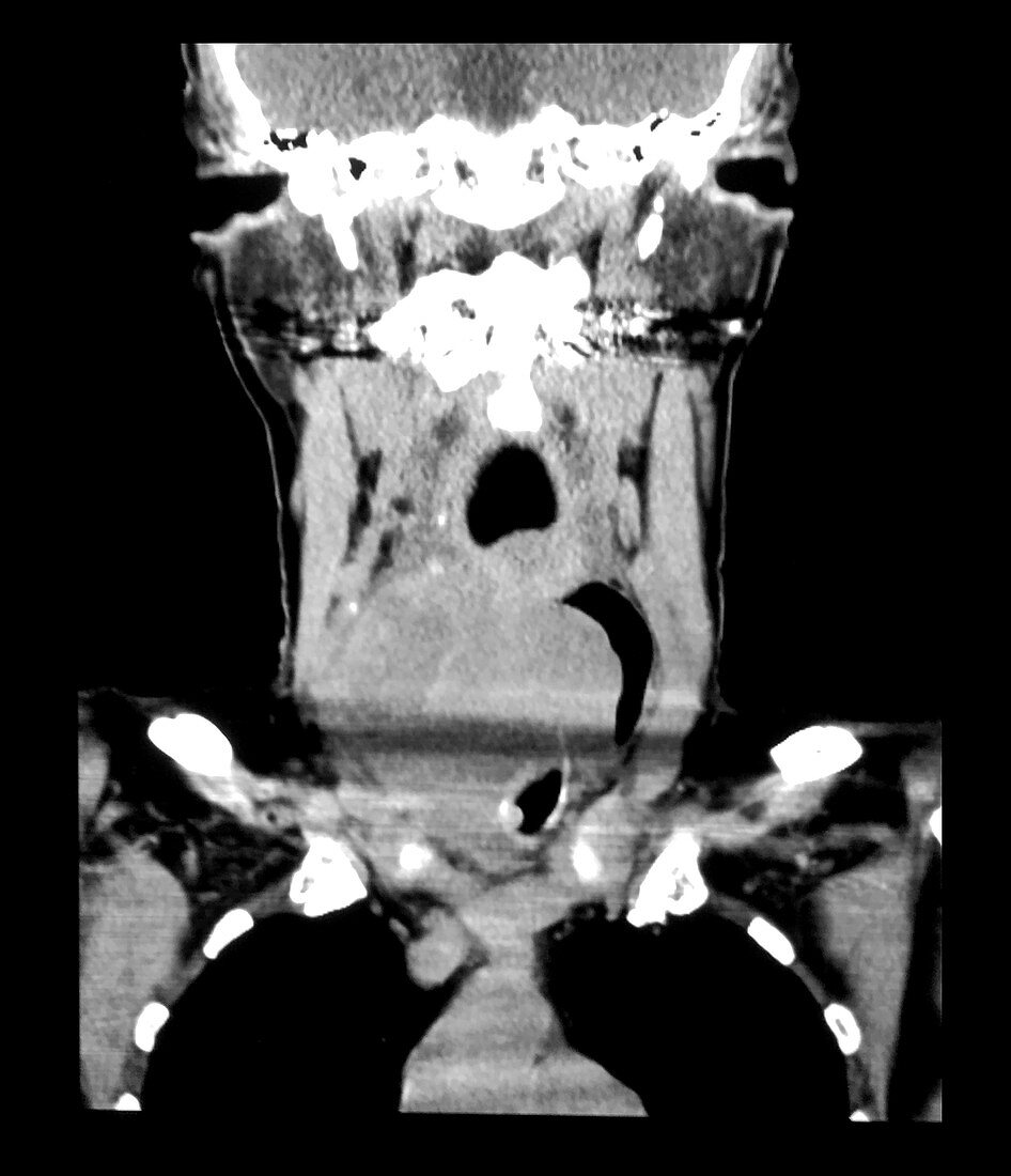 Anaplastic Carcinoma of Thyroid Gland, CT