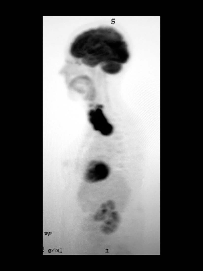 Anaplastic Carcinoma of Thyroid Gland, PET