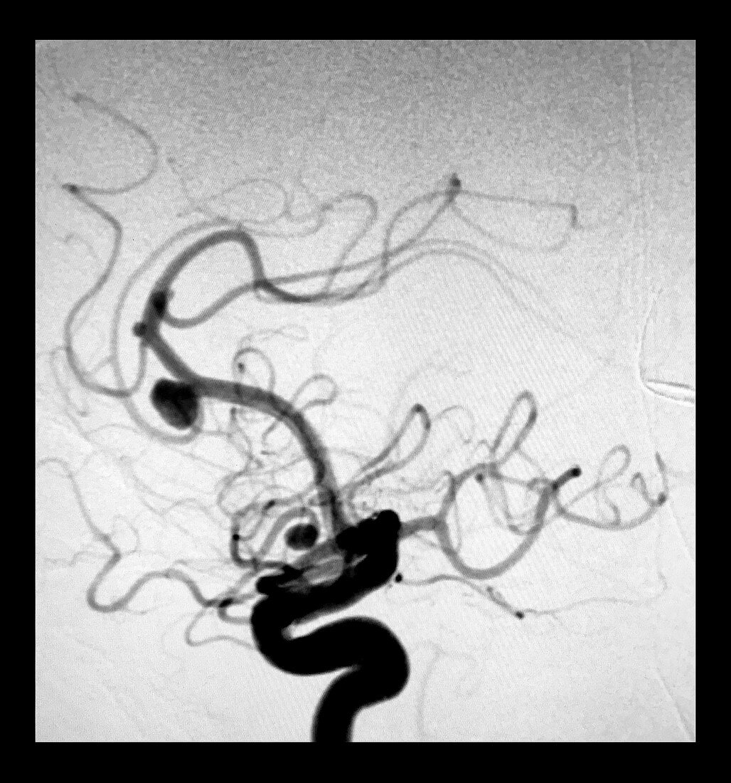 Anterior Cerebral Artery Aneurysm, Angiogram