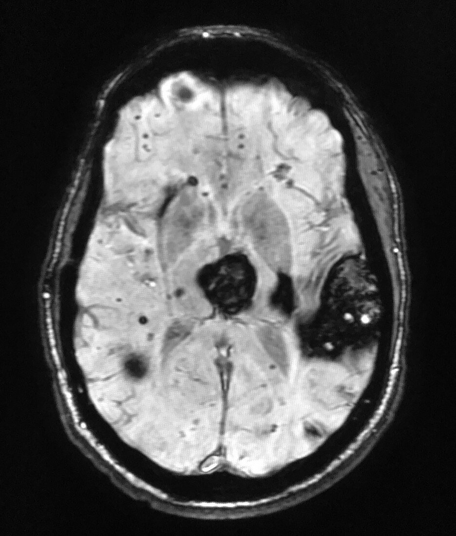 Imaging of Multiple Cavernous Malformations, MR