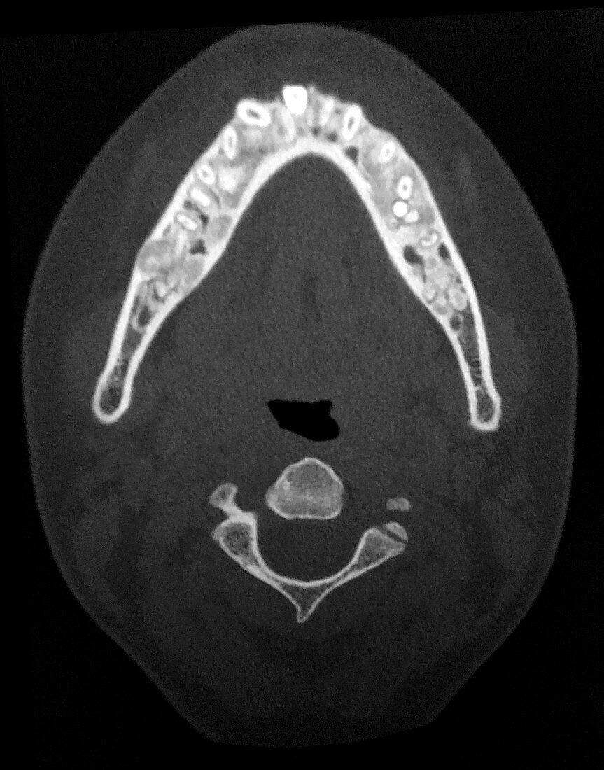 Cemento-Osseous Dysplasia, CT