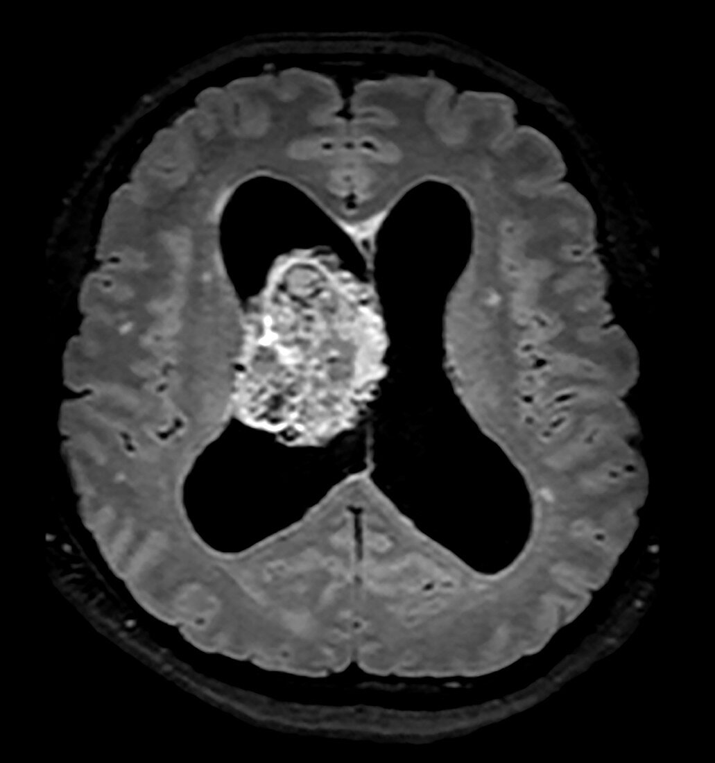 Central Neurocytoma, MRI