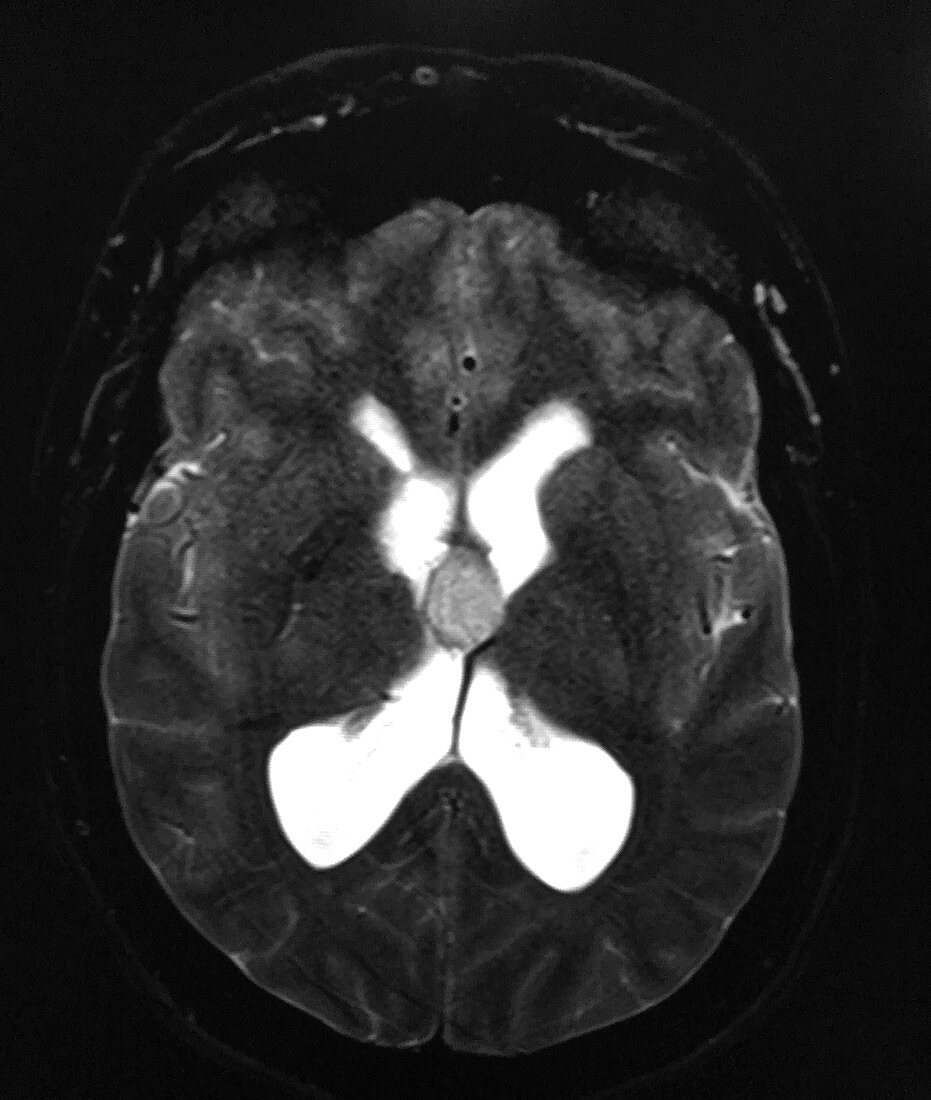 Imaging of Colloid Cyst, MRI